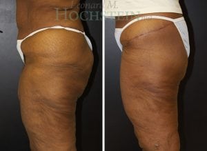Thigh Lift Patient