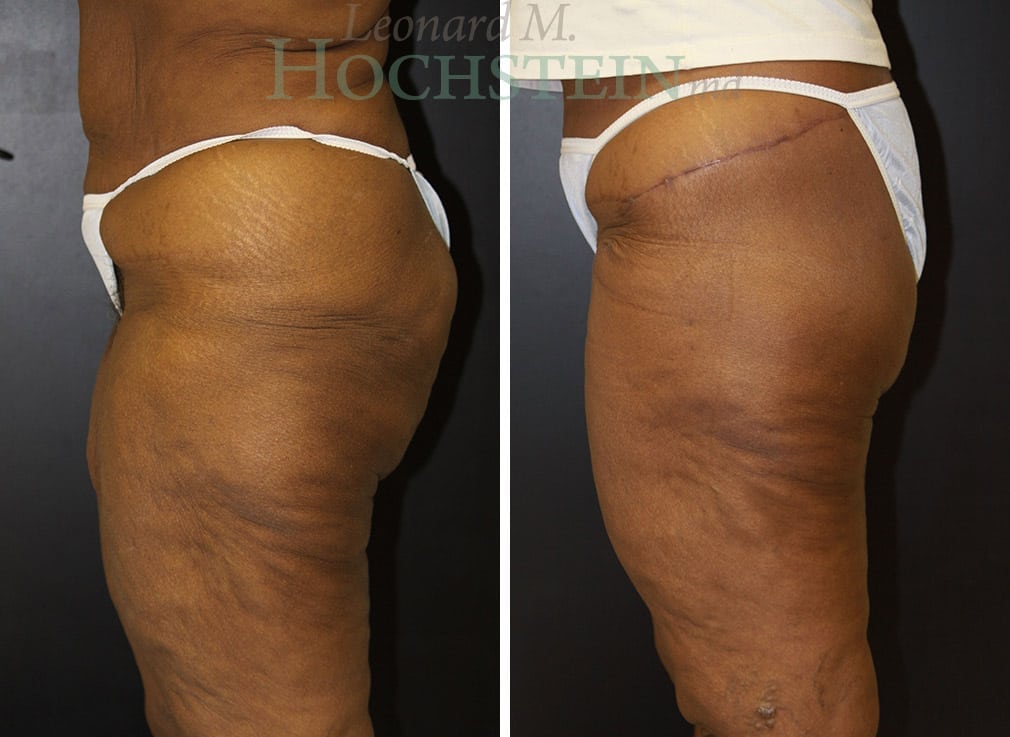 Thigh Lift Patient