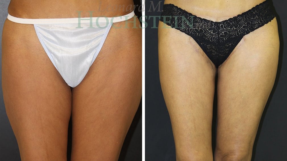 Thigh Lift Patient