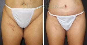 Thigh Lift Patient 04