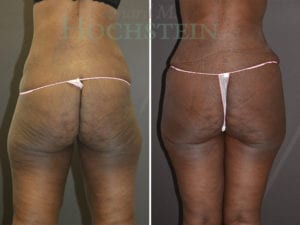 Thigh Lift Patient 05
