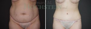 Tummy Tuck Patient