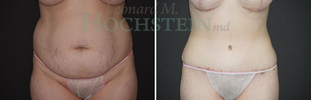 Tummy Tuck Patient