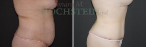 Tummy Tuck Patient