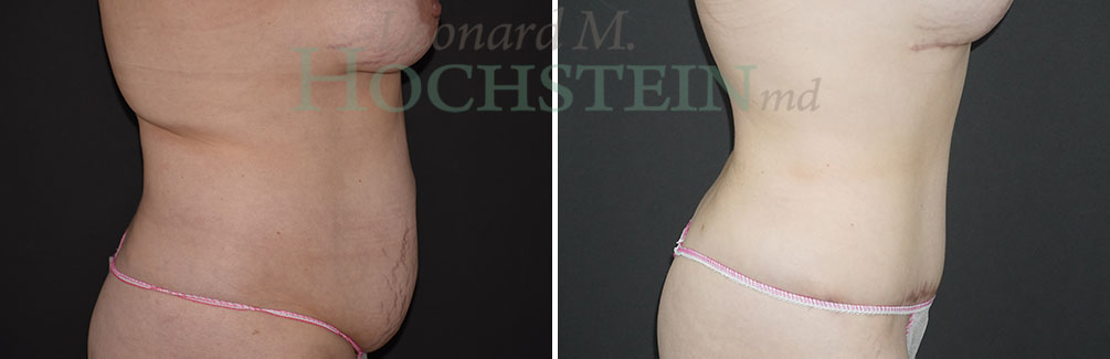 Tummy Tuck Patient