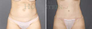 Tummy Tuck Patient