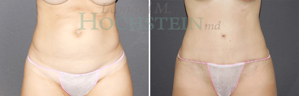 Tummy Tuck Patient