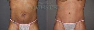 Tummy Tuck Patient
