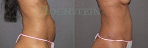 Tummy Tuck Patient