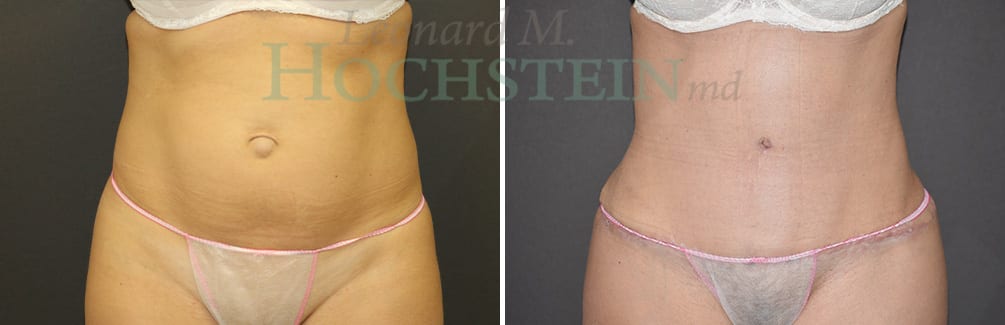 Tummy Tuck Patient