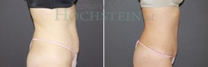 Tummy Tuck Patient
