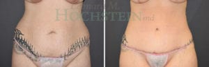 Tummy Tuck Patient