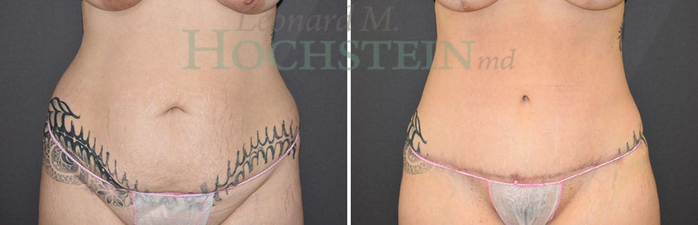 Tummy Tuck Patient