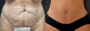 Tummy Tuck Patient 126