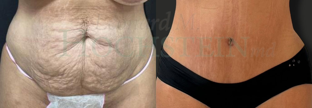 Tummy Tuck Patient