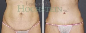 Tummy Tuck Patient