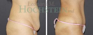 Tummy Tuck Patient