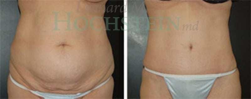 Tummy Tuck Patient
