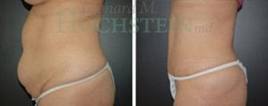 Tummy Tuck Patient