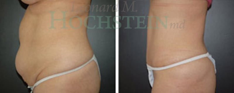 Tummy Tuck Patient
