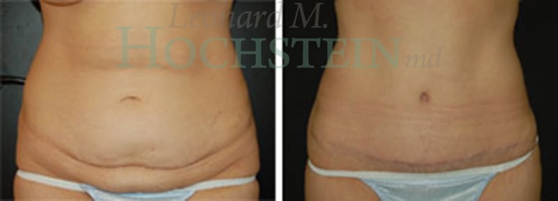 Tummy Tuck Patient