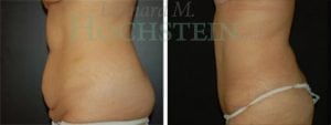 Tummy Tuck Patient