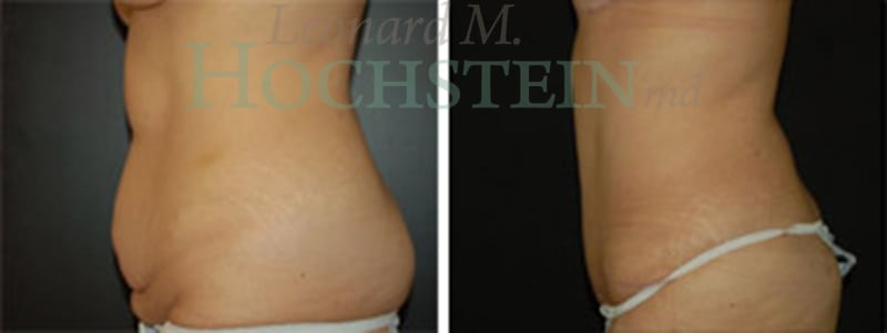 Tummy Tuck Patient