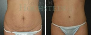 Tummy Tuck Patient