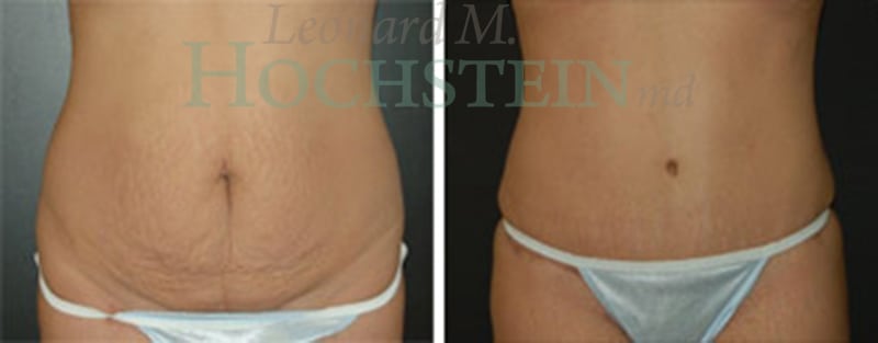 Tummy Tuck Patient