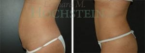 Tummy Tuck Patient