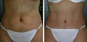 Tummy Tuck Patient