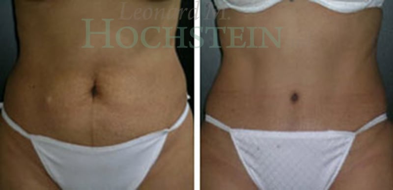 Tummy Tuck Patient
