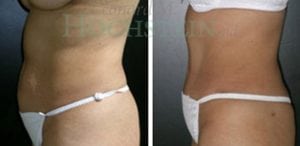 Tummy Tuck Patient