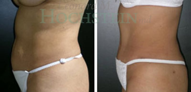 Tummy Tuck Patient