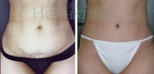 Tummy Tuck Patient