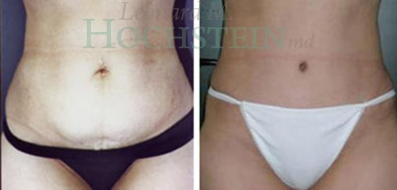Tummy Tuck Patient