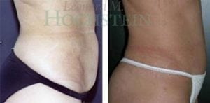 Tummy Tuck Patient