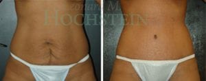 Tummy Tuck Patient