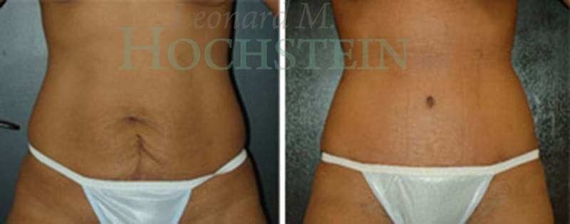 Tummy Tuck Patient
