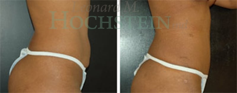 Tummy Tuck Patient