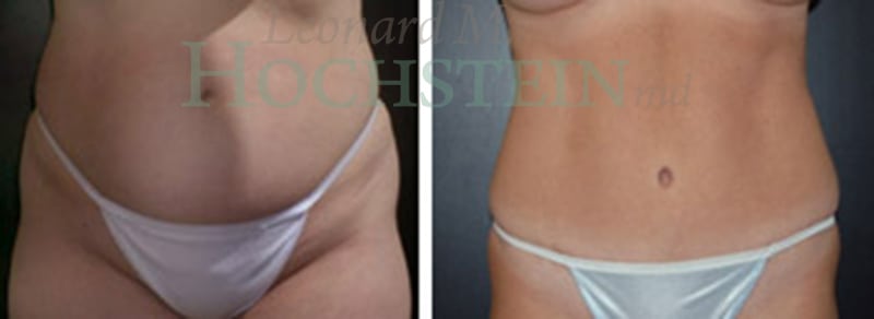 Tummy Tuck Patient