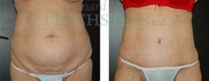 Tummy Tuck Patient