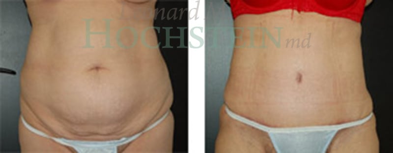 Tummy Tuck Patient