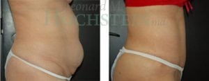 Tummy Tuck Patient