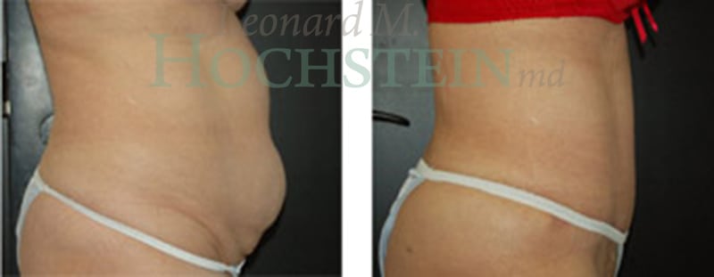 Tummy Tuck Patient