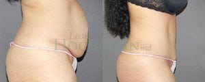 Tummy Tuck Patient