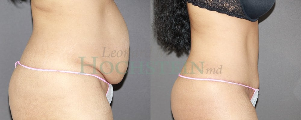 Tummy Tuck Patient