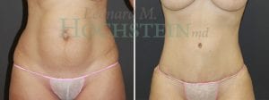 Tummy Tuck Patient
