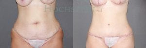 Tummy Tuck Patient