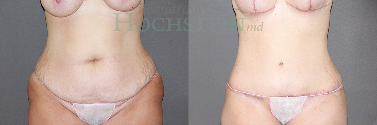 Tummy Tuck Patient